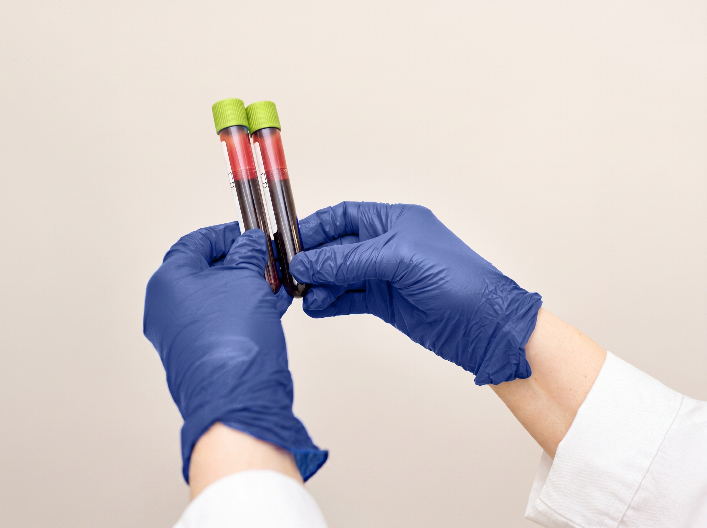 Alzheimer’s Blood Test in Midlife Could Aid Early Detection of Cognitive Decline
