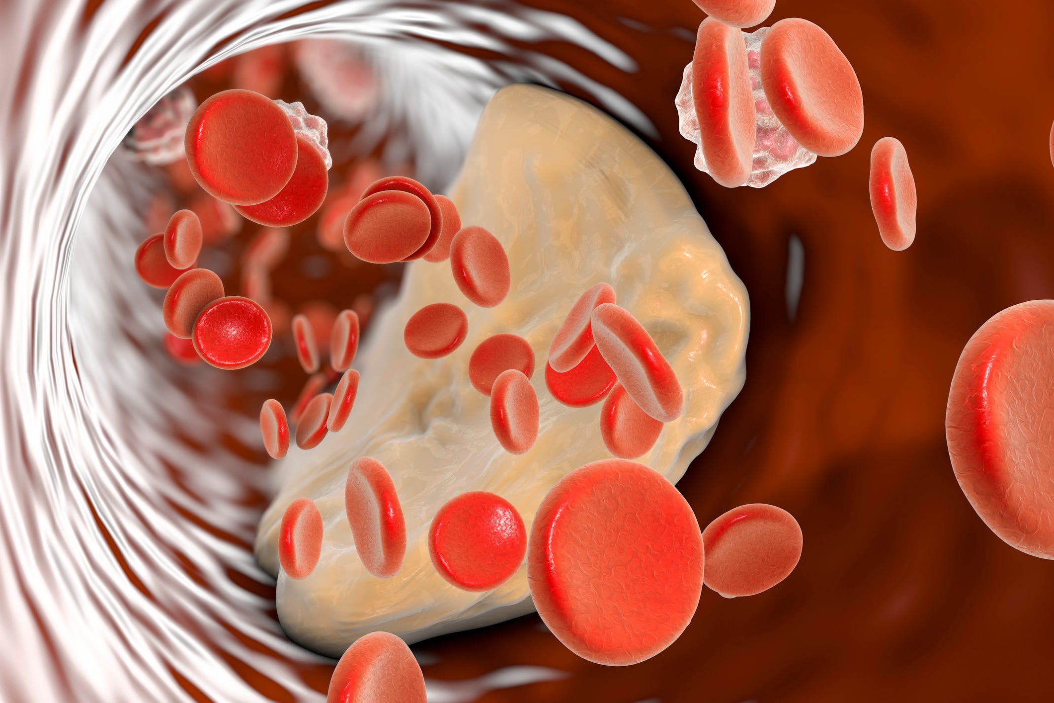 Cardiologists Recommend ApoB Test for Enhanced Cholesterol Assessment