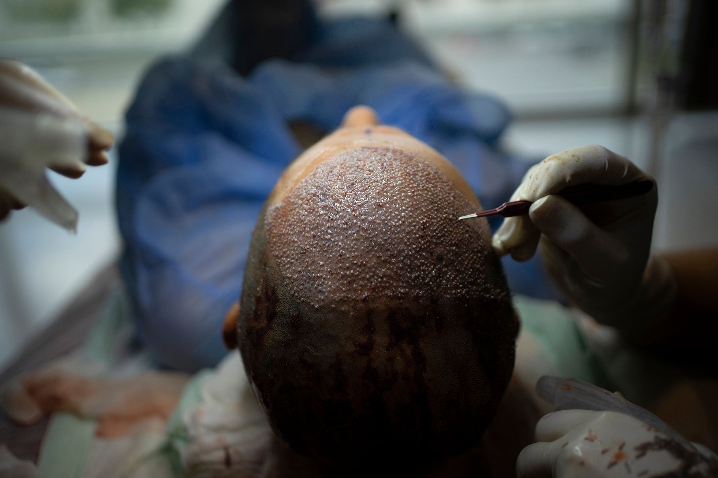 How Turkey Transformed the Hair Transplant Industry